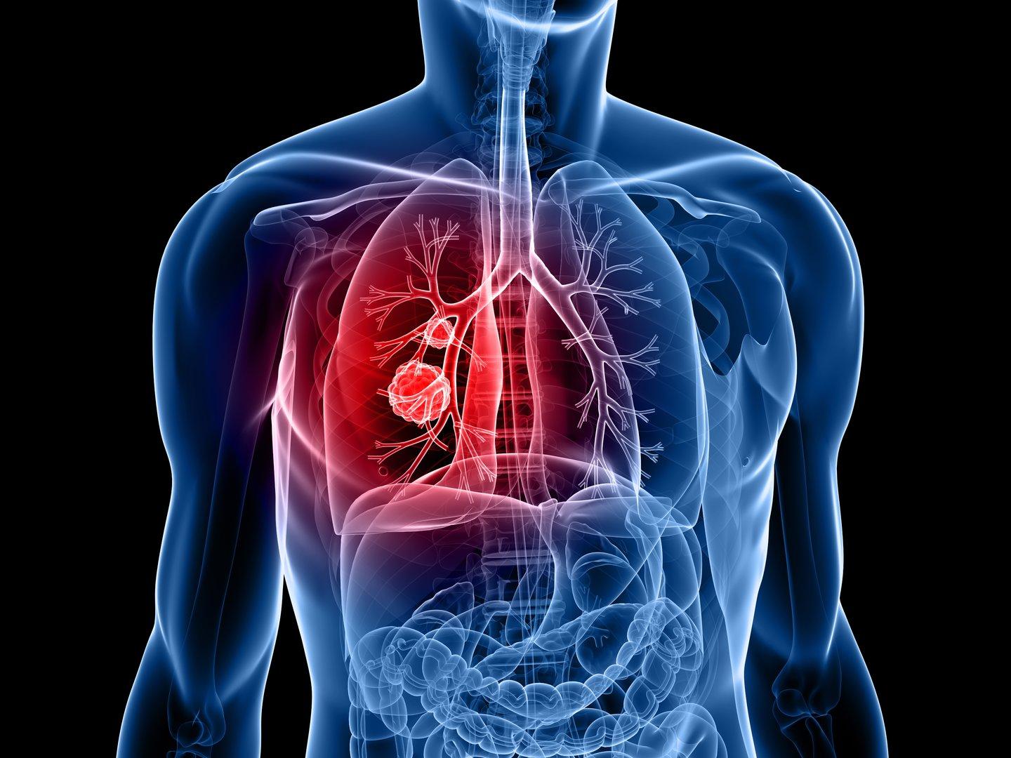 Was die Diagnose Lungenkrebs heute bedeutet