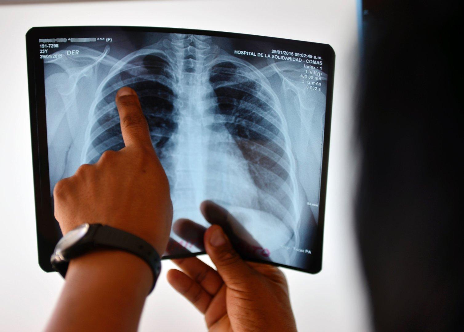 Welttag der Tuberkulose: Auch in Österreich sterben Patienten