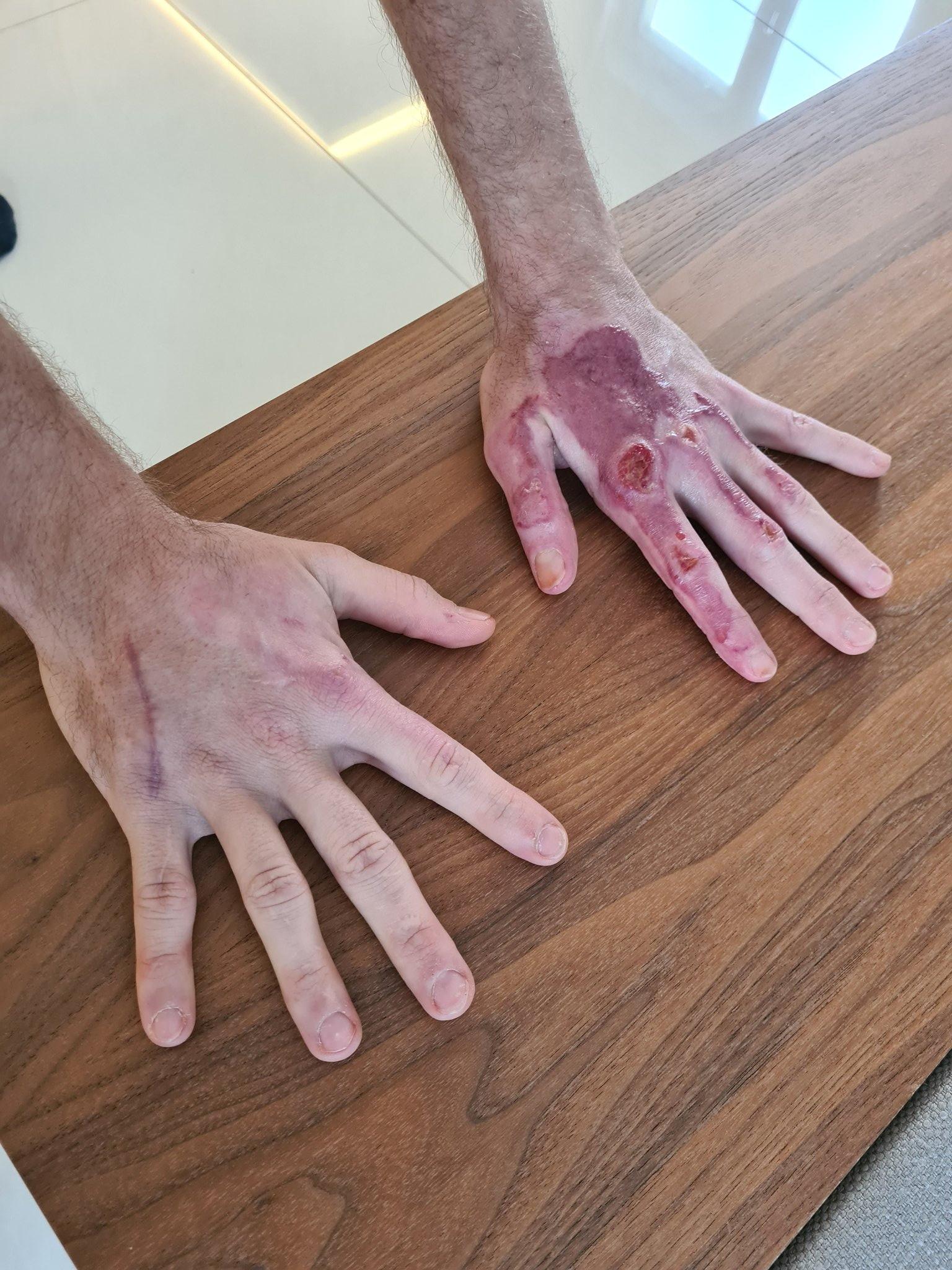 Romain Grosjean's hands are seen post-accident Romain Grosjean's hands are seen post-accident