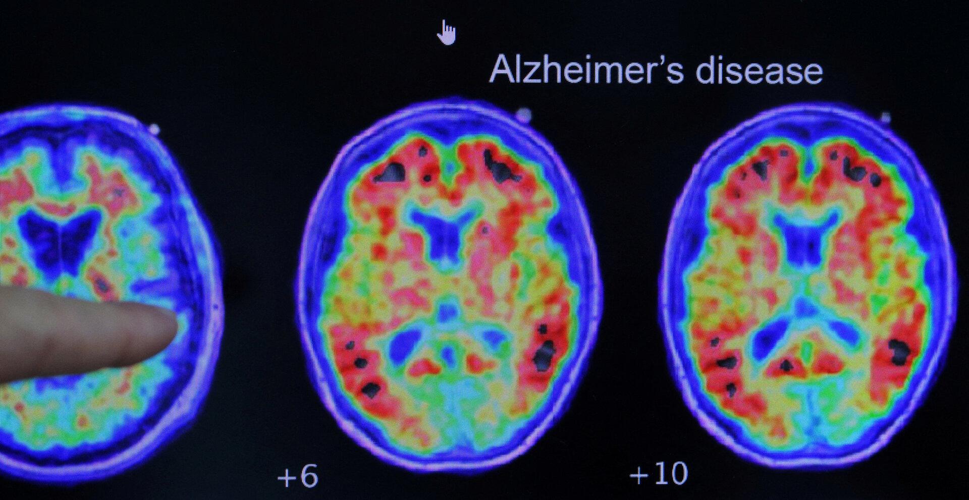 Bedenken ausgeräumt: Arzneiagentur empfiehlt weiteres Alzheimer-Mittel