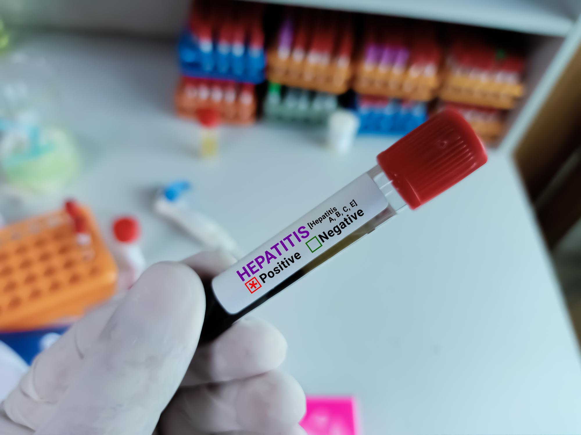 Chronische Hepatitis B: Neues Medikament macht Hoffnung
